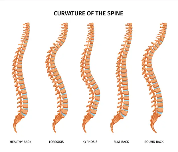 Kyphosis (Hunchback) Treatment
