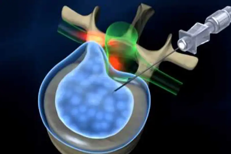 Nucleoplasty