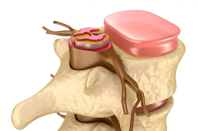 Nucleoplasty