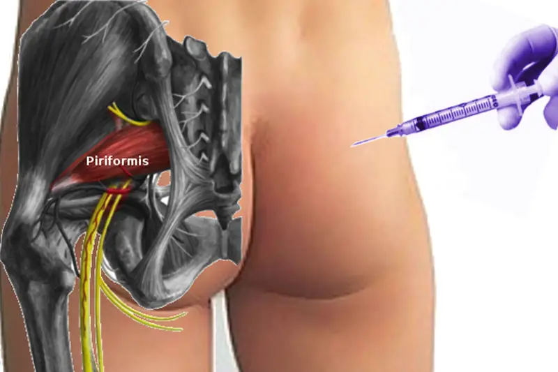 Piriformis Injection