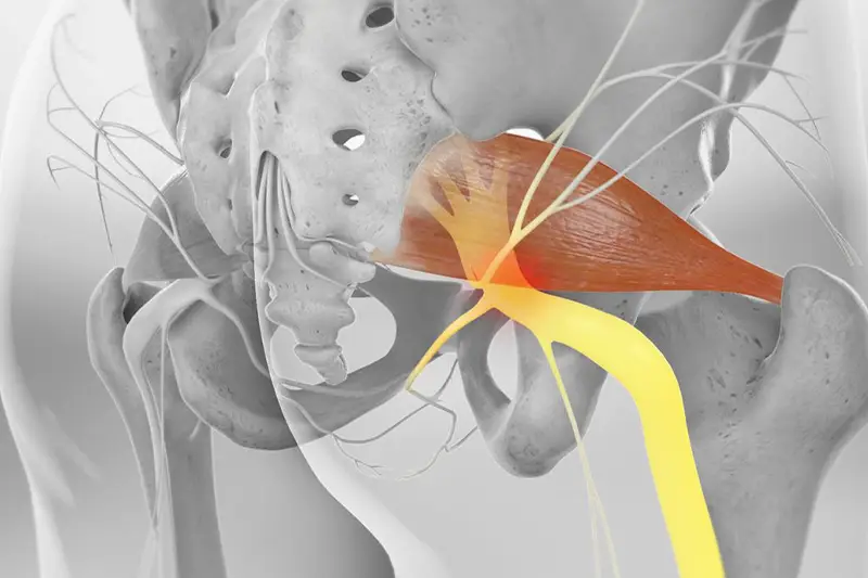 Piriformis Injection