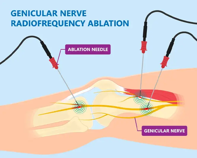 Radiofrequency Nerve Block