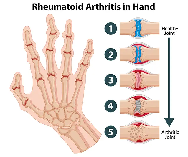 Rheumatoid Arthritis Treatment