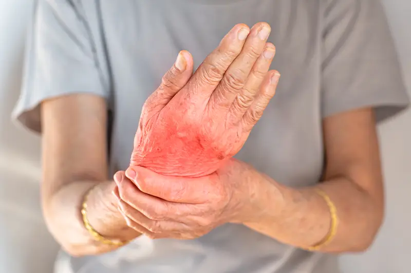 Rheumatoid Arthritis Treatment