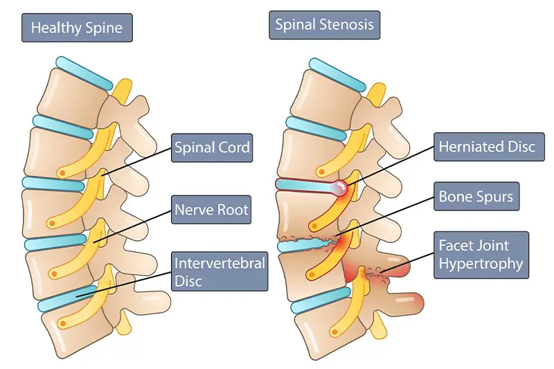 Spinal Stenosis