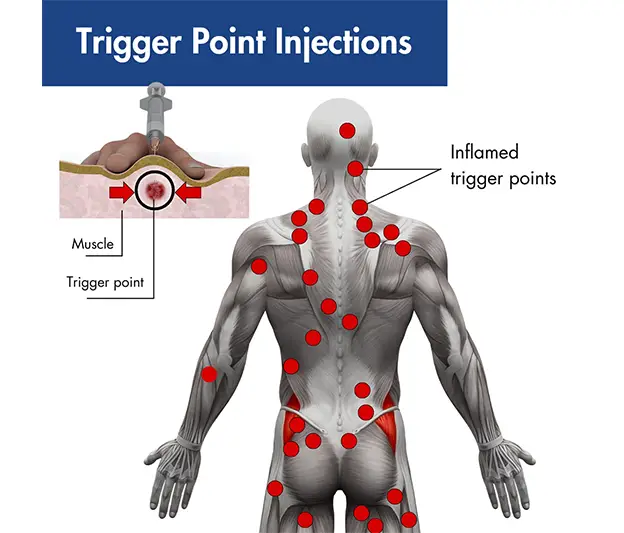 Trigger Point Injections
