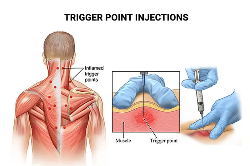 Trigger Point Injections